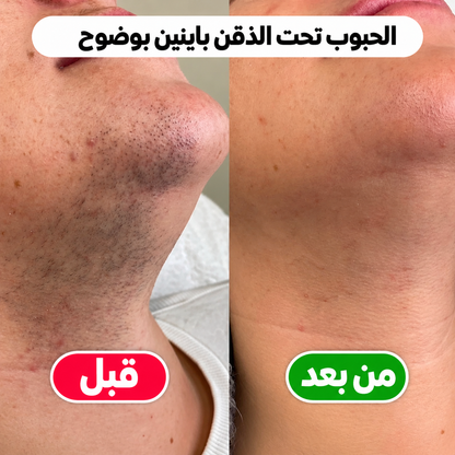 ماكينة إزالة الشعر 2 في 1 – بشرة ناعمة بسهولة