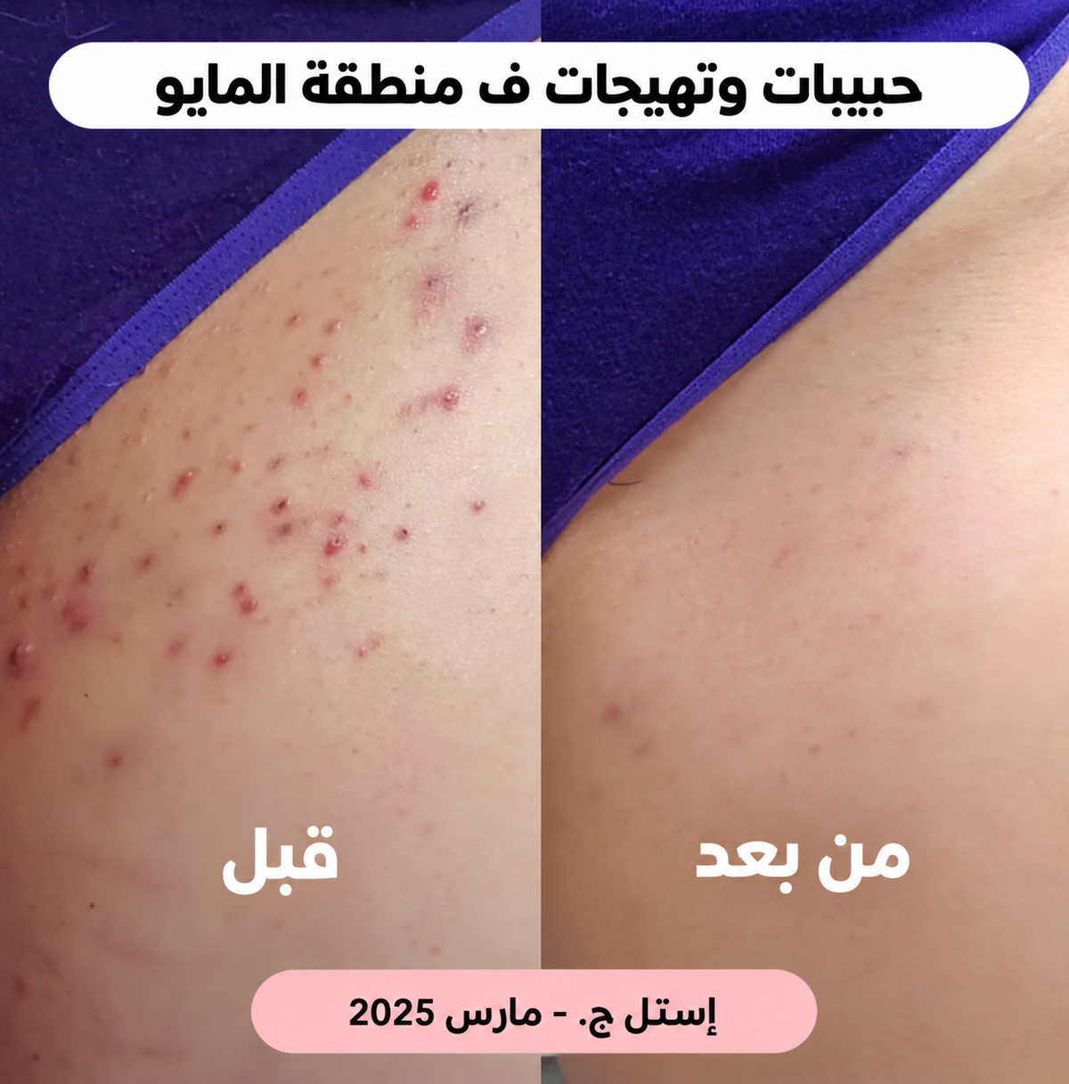 ماكينة إزالة الشعر 2 في 1 – بشرة ناعمة بسهولة