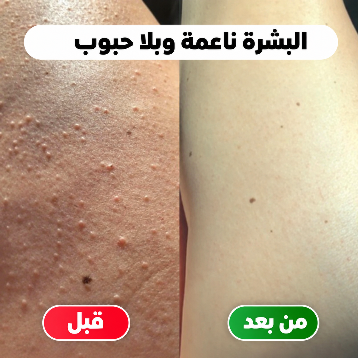 ماكينة إزالة الشعر 2 في 1 – بشرة ناعمة بسهولة