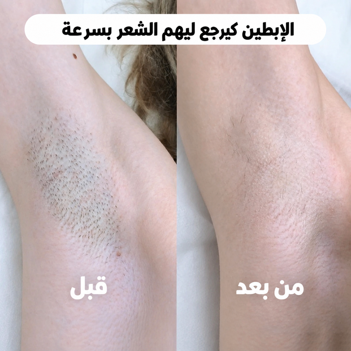 ماكينة إزالة الشعر 2 في 1 – بشرة ناعمة بسهولة